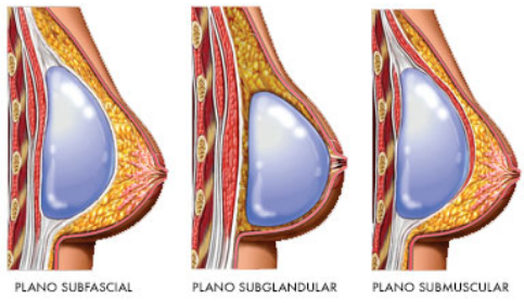 Planos cirúrgicos da mamoplastia de aumento