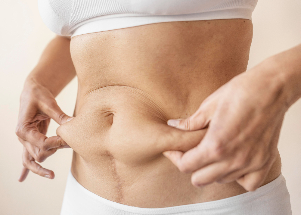 Abdominoplastia segue como tendência